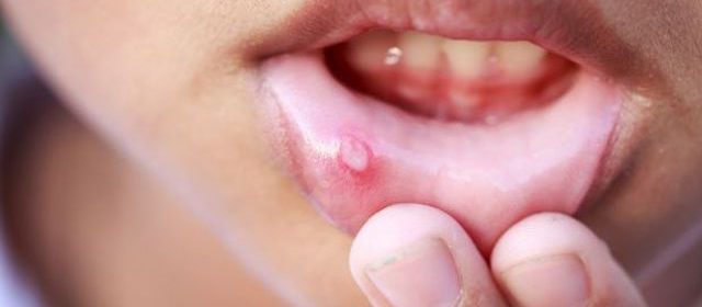 Zapalenie jamy ustnej – przyczyny, rodzaje, leczenie